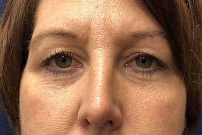Eyelid Surgery Before & After Gallery - Patient 361011 - Image 1