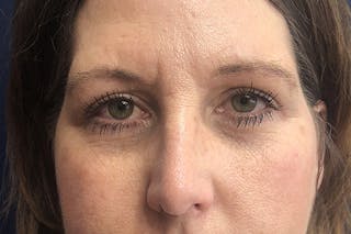 Eyelid Surgery Before & After Gallery - Patient 361011 - Image 2