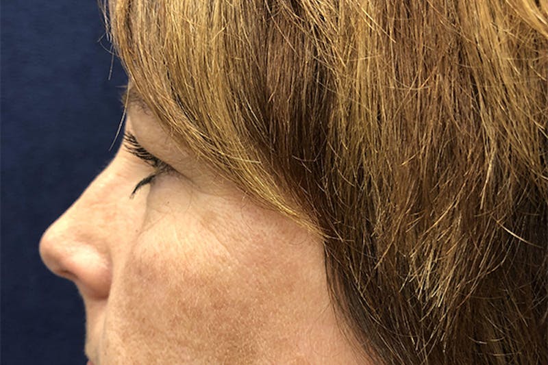 Eyelid Surgery Before & After Gallery - Patient 361011 - Image 3