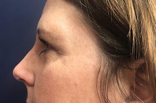 Eyelid Surgery Before & After Gallery - Patient 361011 - Image 4