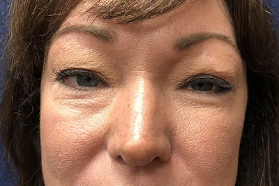 Eyelid Surgery Before & After Gallery - Patient 207074 - Image 1