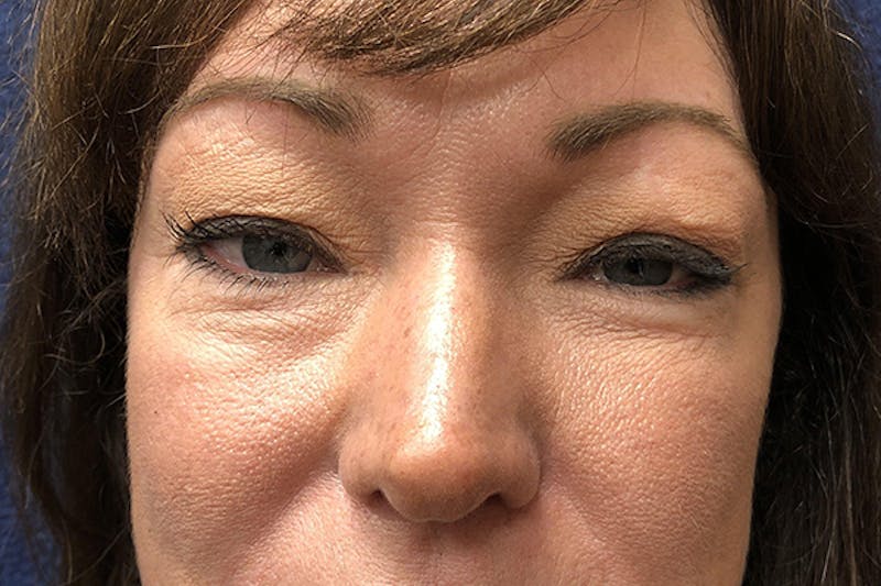 Eyelid Surgery Before & After Gallery - Patient 207074 - Image 1