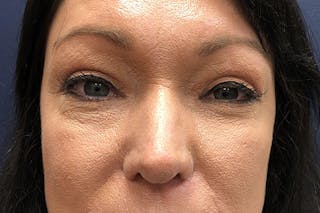 Eyelid Surgery Before & After Gallery - Patient 207074 - Image 2