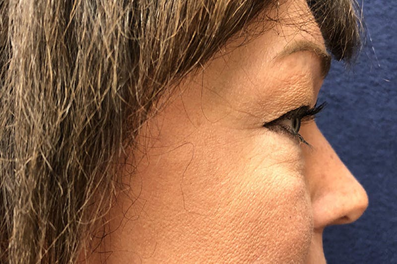 Eyelid Surgery Before & After Gallery - Patient 207074 - Image 3