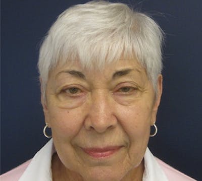 Eyelid Surgery Before & After Gallery - Patient 597950 - Image 1