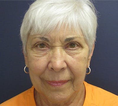 Eyelid Surgery Before & After Gallery - Patient 597950 - Image 2