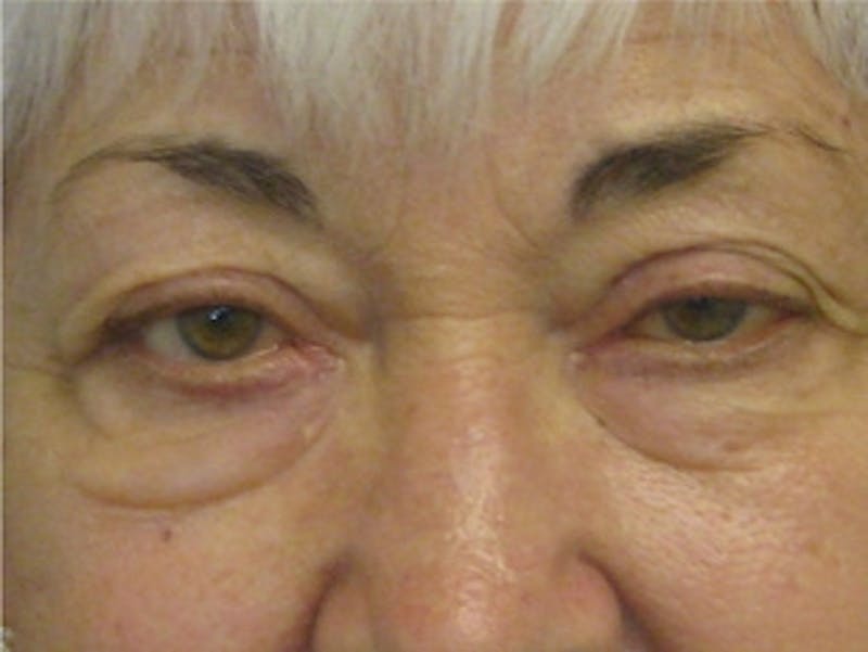 Eyelid Surgery Before & After Gallery - Patient 597950 - Image 3