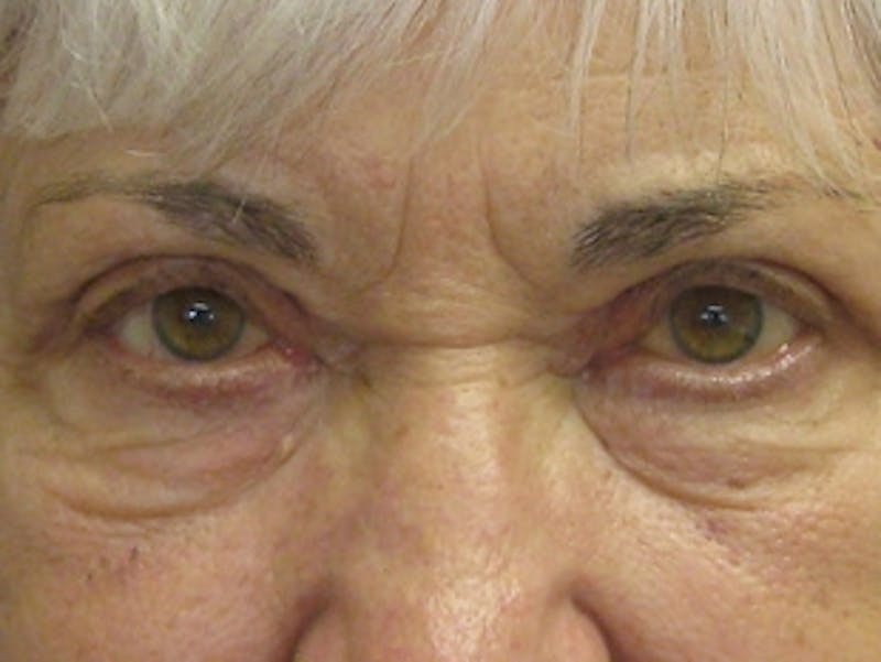Eyelid Surgery Before & After Gallery - Patient 597950 - Image 4