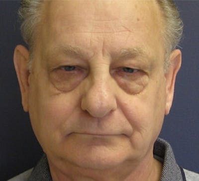 Eyelid Surgery Before & After Gallery - Patient 561765 - Image 1