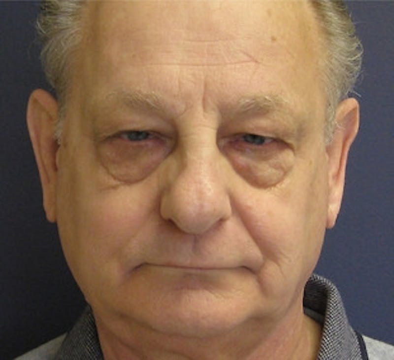 Eyelid Surgery Before & After Gallery - Patient 561765 - Image 1