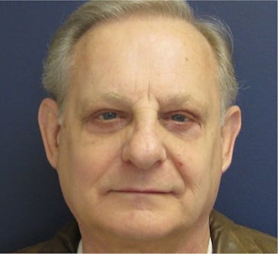 Eyelid Surgery Before & After Gallery - Patient 561765 - Image 2