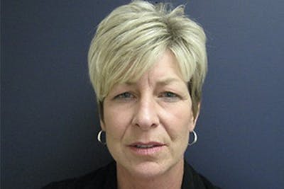 Eyelid Surgery Before & After Gallery - Patient 211954 - Image 1