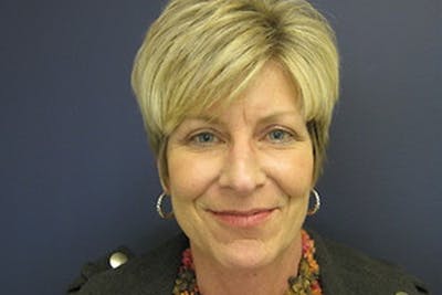 Eyelid Surgery Before & After Gallery - Patient 211954 - Image 2