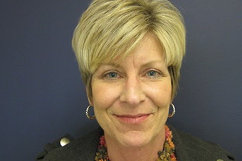 Eyelid Surgery Before & After Gallery - Patient 211954 - Image 2
