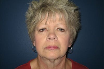 Eyelid Surgery Before & After Gallery - Patient 726686 - Image 1