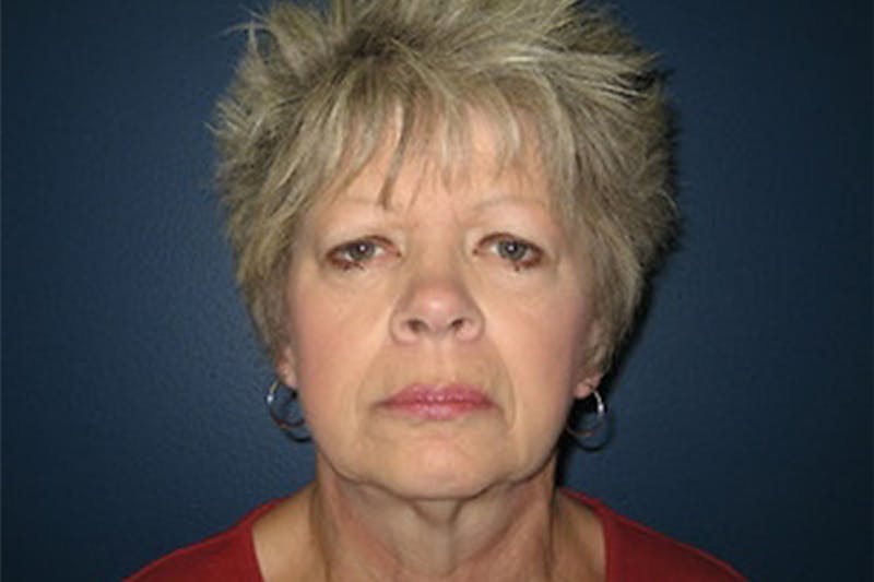 Eyelid Surgery Before & After Gallery - Patient 726686 - Image 1