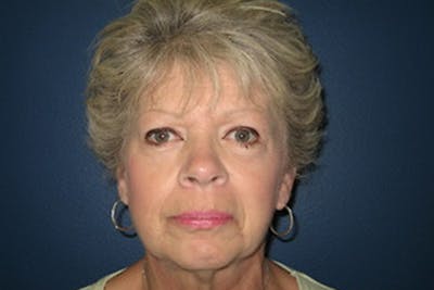 Eyelid Surgery Before & After Gallery - Patient 726686 - Image 2