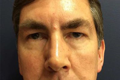 Eyelid Surgery Before & After Gallery - Patient 217504 - Image 1