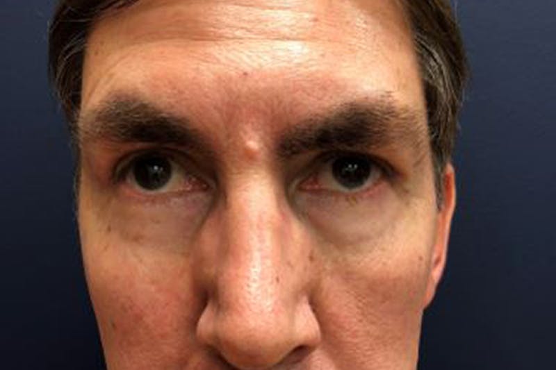 Eyelid Surgery Before & After Gallery - Patient 217504 - Image 2