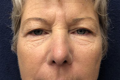 Eyelid Surgery Before & After Gallery - Patient 279501 - Image 1