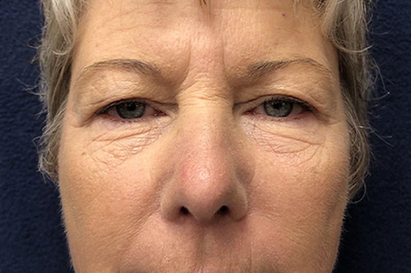 Eyelid Surgery Before & After Gallery - Patient 279501 - Image 1