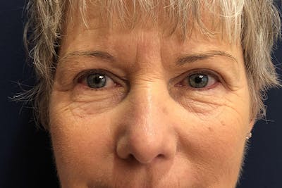 Eyelid Surgery Before & After Gallery - Patient 279501 - Image 2