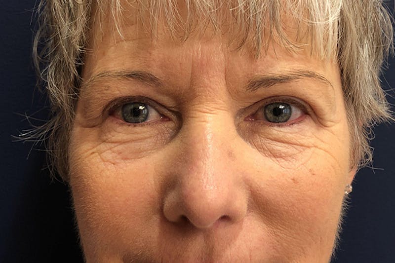 Eyelid Surgery Before & After Gallery - Patient 279501 - Image 2