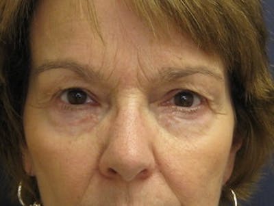 Eyelid Surgery Before & After Gallery - Patient 295708 - Image 1