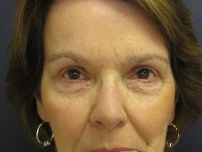 Eyelid Surgery Before & After Gallery - Patient 295708 - Image 2