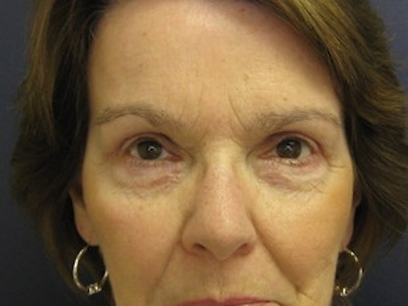 Eyelid Surgery Before & After Gallery - Patient 295708 - Image 2