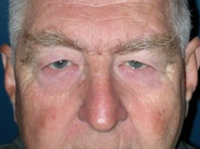 Eyelid Surgery Before & After Gallery - Patient 324443 - Image 1