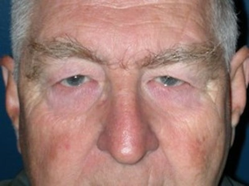Eyelid Surgery Before & After Gallery - Patient 324443 - Image 1