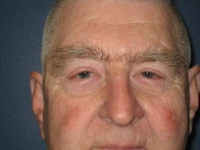 Eyelid Surgery Before & After Gallery - Patient 324443 - Image 2
