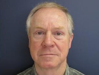 Eyelid Surgery Before & After Gallery - Patient 351300 - Image 2