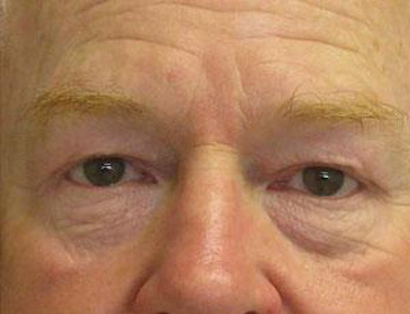 Eyelid Surgery Before & After Gallery - Patient 351300 - Image 3