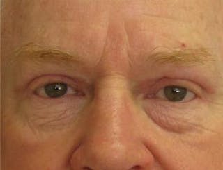 Eyelid Surgery Before & After Gallery - Patient 351300 - Image 4
