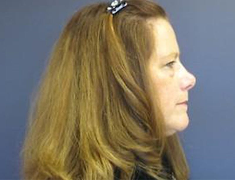 Eyelid Surgery Before & After Gallery - Patient 142253 - Image 3