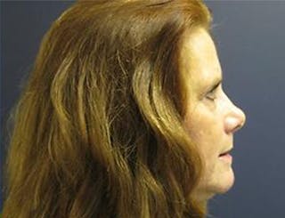 Eyelid Surgery Before & After Gallery - Patient 142253 - Image 4