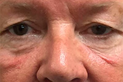 Eyelid Surgery Before & After Gallery - Patient 112872 - Image 1