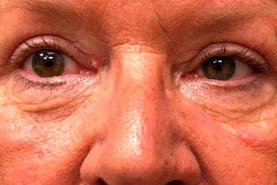 Eyelid Surgery Before & After Gallery - Patient 112872 - Image 2