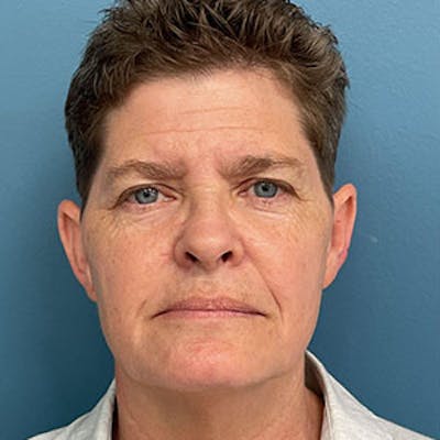 Facelift Before & After Gallery - Patient 264227 - Image 1