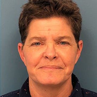 Facelift Before & After Gallery - Patient 264227 - Image 2