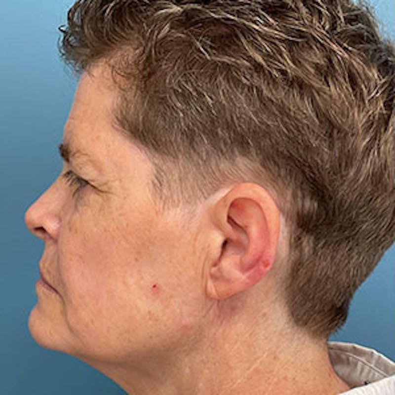 Facelift Before & After Gallery - Patient 264227 - Image 3