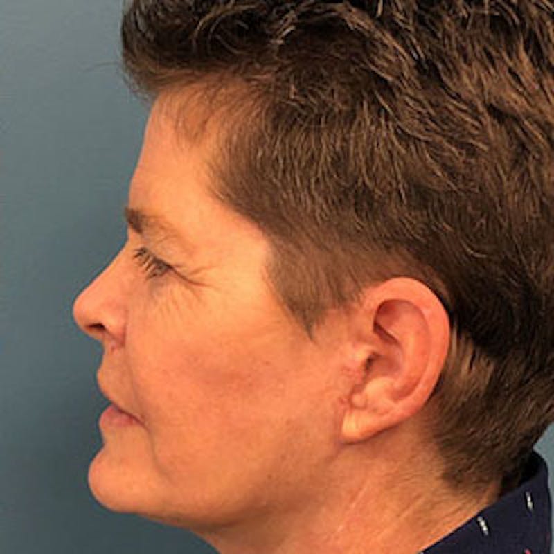 Facelift Before & After Gallery - Patient 264227 - Image 4