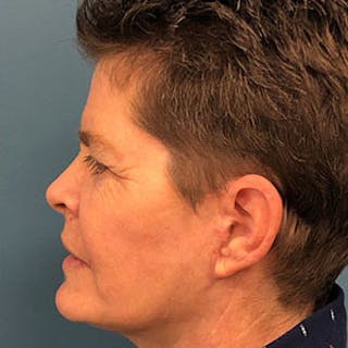 Facelift Before & After Gallery - Patient 264227 - Image 4