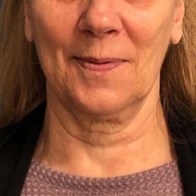 Facelift Before & After Gallery - Patient 303858 - Image 1