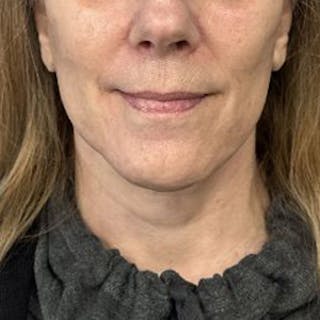 Facelift Before & After Gallery - Patient 303858 - Image 2