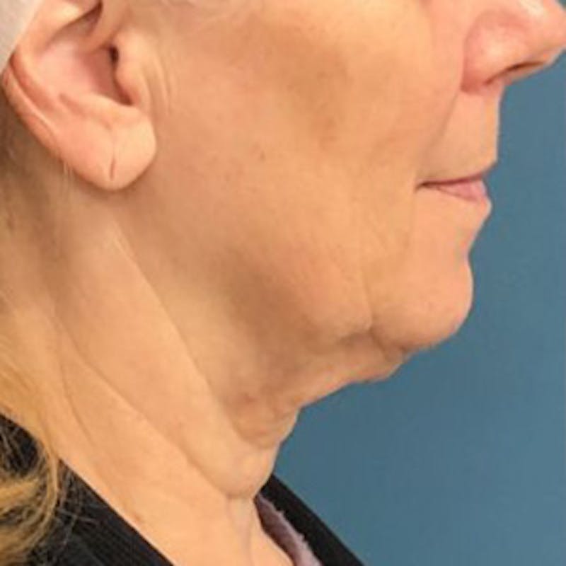 Facelift Before & After Gallery - Patient 303858 - Image 3
