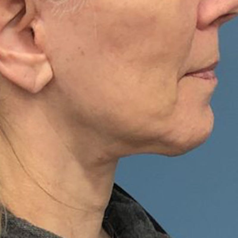 Facelift Before & After Gallery - Patient 303858 - Image 4