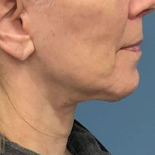 Facelift Before & After Gallery - Patient 303858 - Image 4